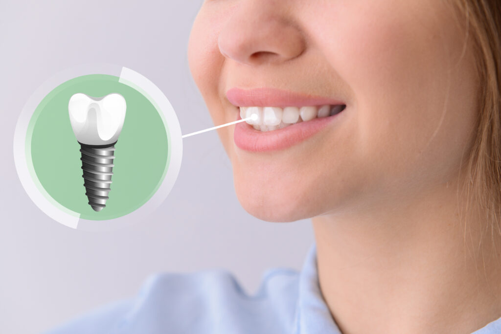 dental implants tomball tx