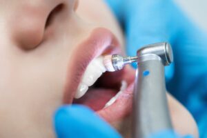 professional teeth whitening houston